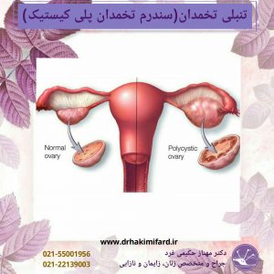 تنبلی تخمدان یا سندرم تخمدان پلی کیستیک(PCOS)