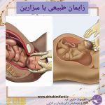 زایمان طبیعی یا سزارین؟