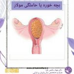 بچه خوره یا حاملگی مولار