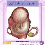 فیبروم و بارداری